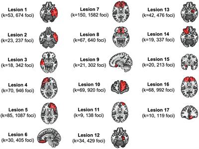 The origins of evil: From lesions to the functional architecture of the antisocial brain